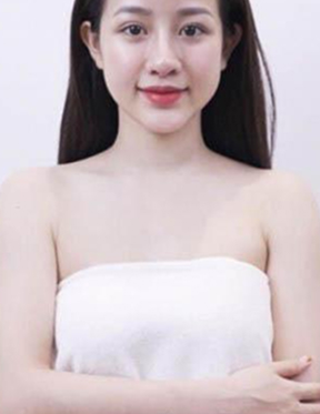 Trước sau cắt cánh mũi 2