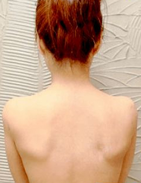 Trước sau cắt cánh mũi 3
