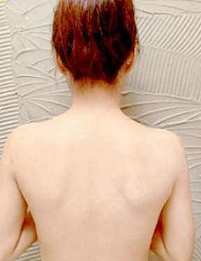 Trước sau cắt cánh mũi 4
