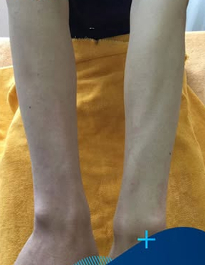 Trước sau cắt cánh mũi 2