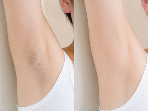 Trước và sau triệt lông nách bằng Diode Laser của khách hàng Lệ Quyên tại Kangnam