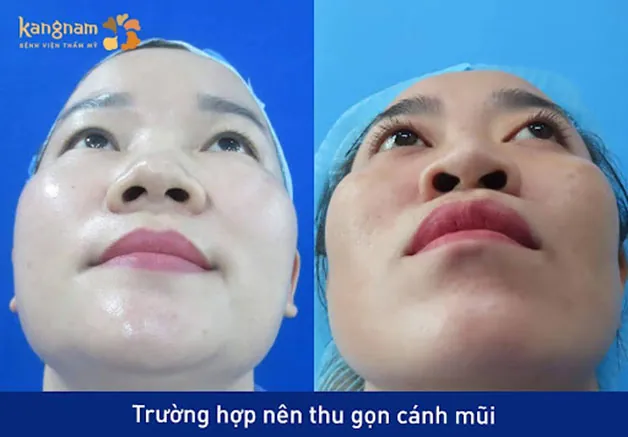 Trước sau cắt cánh mũi 1
