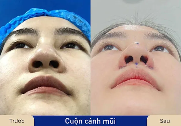Trước sau cắt cánh mũi 2