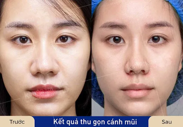 Trước sau cắt cánh mũi 3
