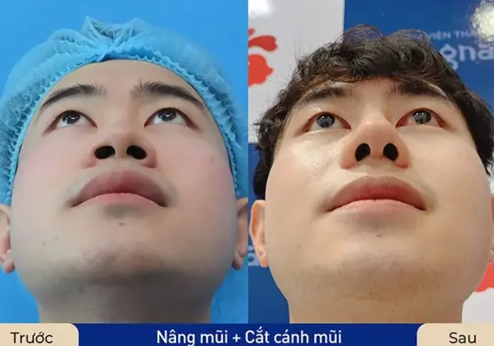 Trước sau cắt cánh mũi 4