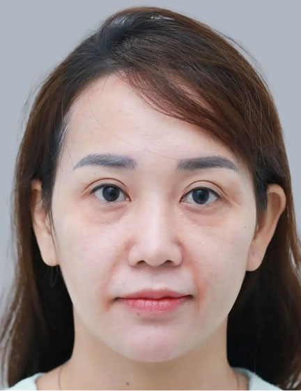 Trước sau cắt cánh mũi 1