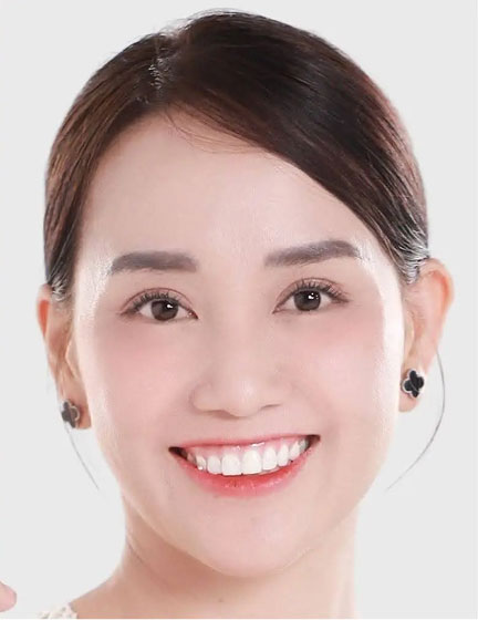 Trước sau cắt cánh mũi 2