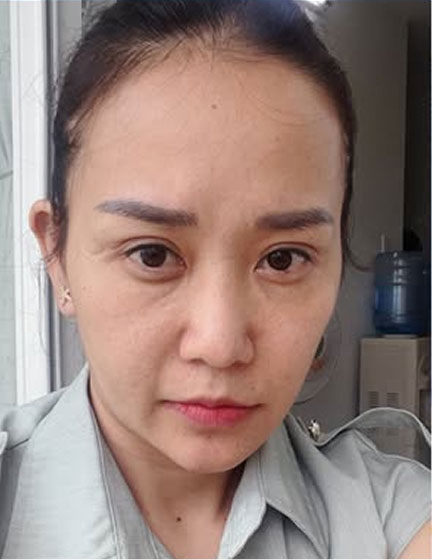Trước sau cắt cánh mũi 3