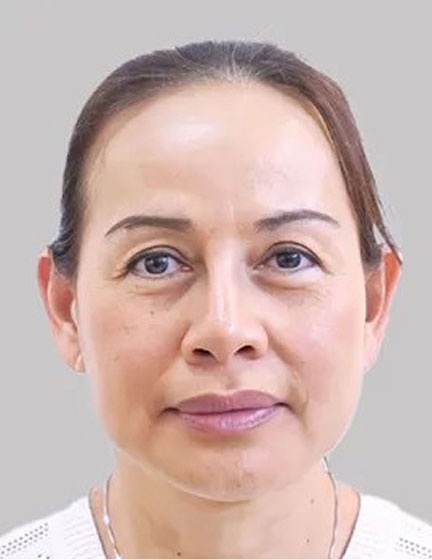 Trước sau cắt cánh mũi 1