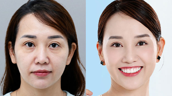 Trước và sau căng chỉ X-line của khách hàng Hoàng Yến tại Kangnam