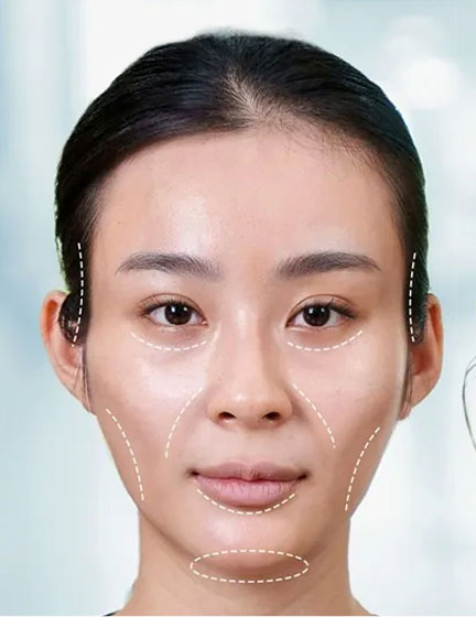 Trước sau cắt cánh mũi 1