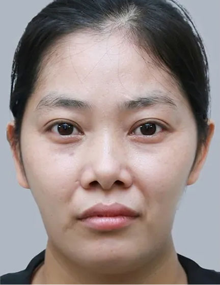 Trước sau cắt cánh mũi 3