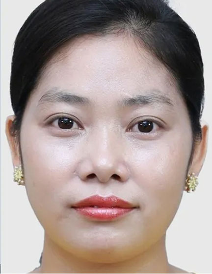 Trước sau cắt cánh mũi 4
