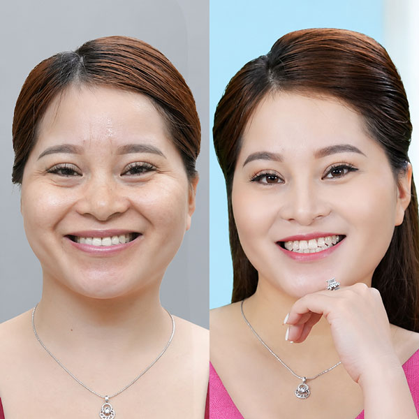 Trước và sau tiêm trẻ hóa da Meso HA tại Kangnam