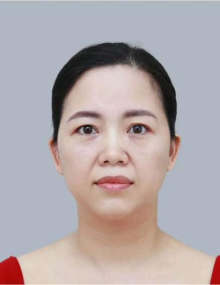 Trước sau cắt cánh mũi 1