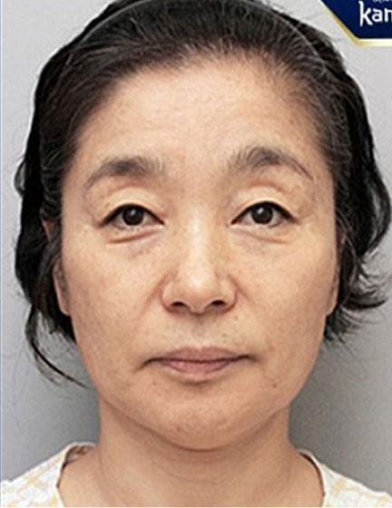 Trước sau cắt cánh mũi 3