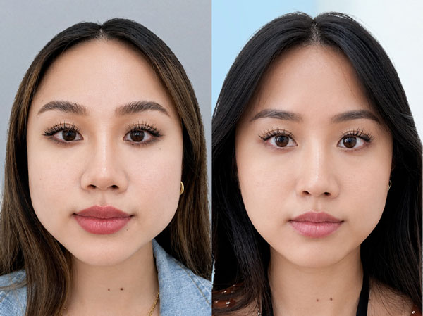 Nâng cơ Ultherapy Prime thon gọn viền hàm, giảm nọng cằm tại Kangnam