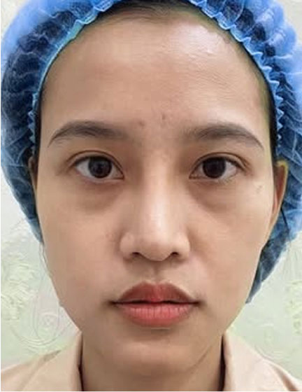 Trước sau cắt cánh mũi 1
