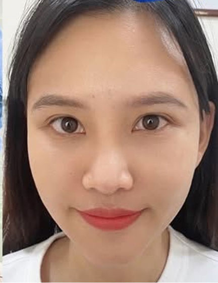 Trước sau cắt cánh mũi 2