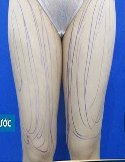 Trước sau cắt cánh mũi 3