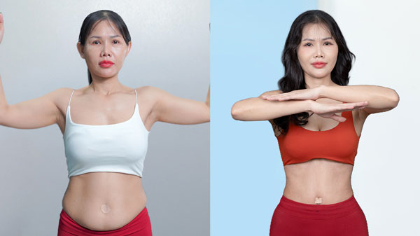 Khách hàng Hoàng Diễm sau hút mỡ bụng tại Bệnh viện Thẩm mỹ Kangnam