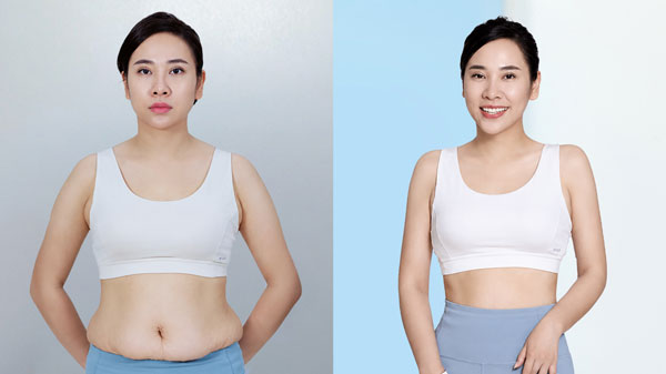Trước và sau hút mỡ của diễn viên Gumi Nhật tại Kangnam