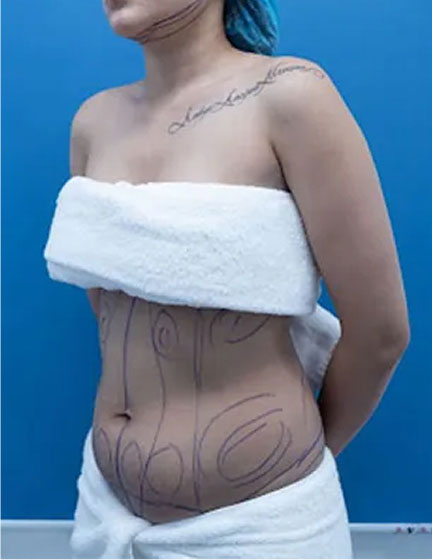 Trước sau cắt cánh mũi 1