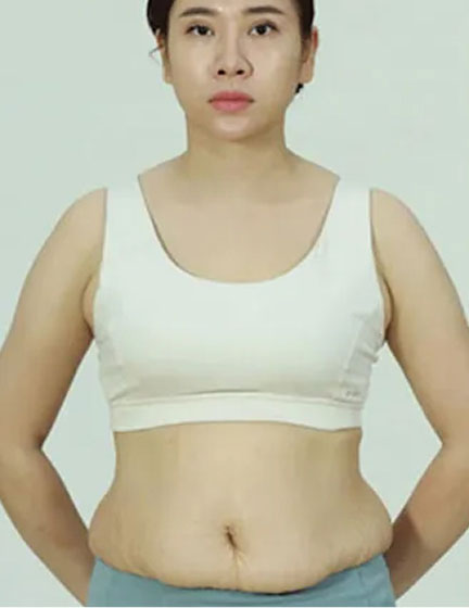 Trước sau cắt cánh mũi 3