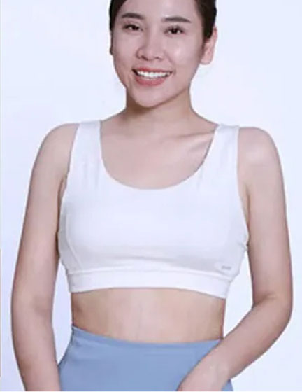 Trước sau cắt cánh mũi 4