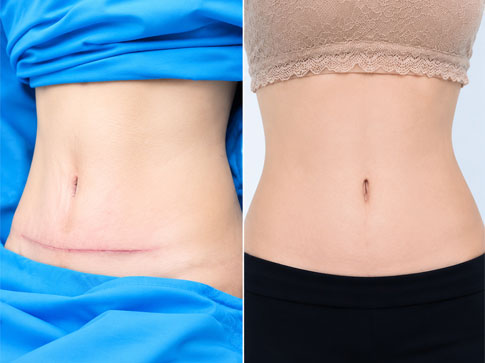 Trước và sau tạo hình thành bụng toàn phần sau sinh - sẹo viền bikini mờ dần sau 6 tháng tại Kangnam