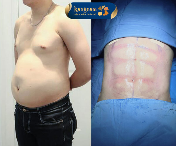 Trước và sau hút mỡ định hình thành bụng nam giới tại Kangnam