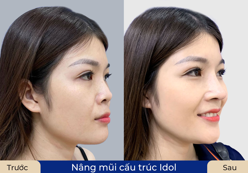 Khách hàng nâng mũi cấu trúc Idol tại Kangnam
