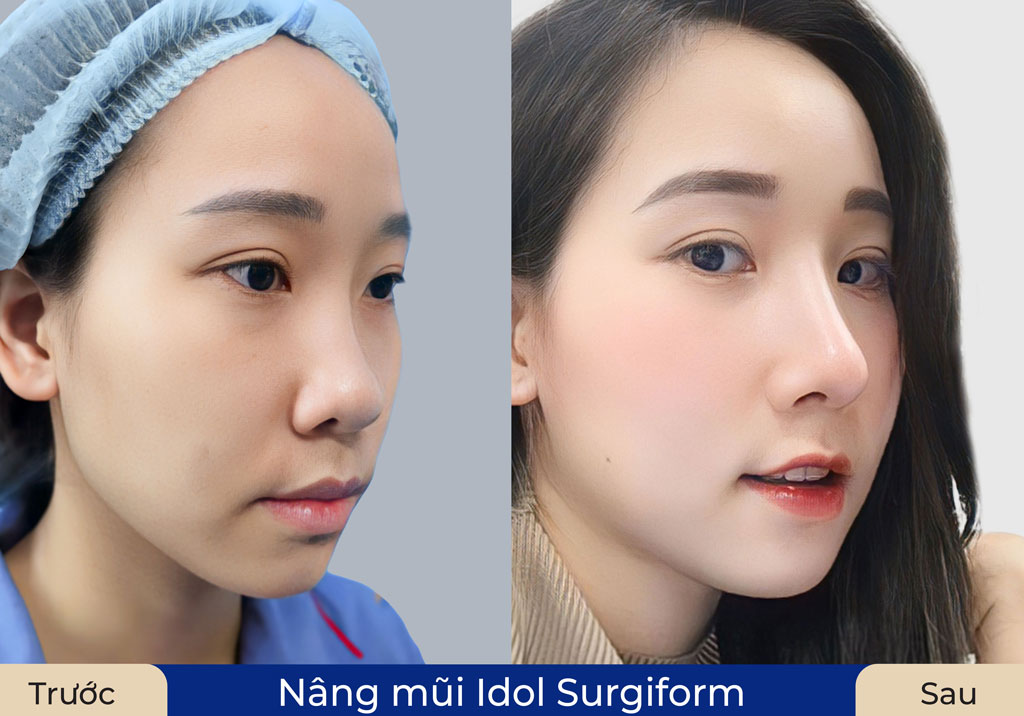 Khách hàng nâng mũi thẩm mỹ tại Kangnam