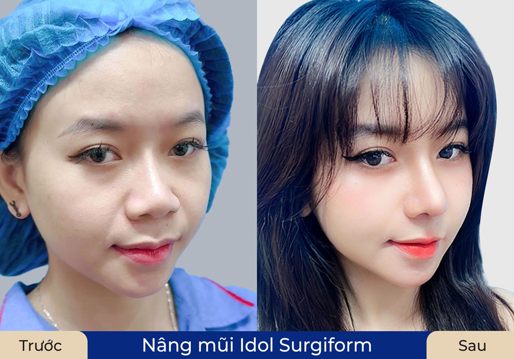 Khách hàng khắc phục mũi hỏng tại Kangnam
