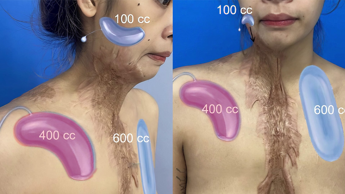 DIỆU LINH ĐẶT TÚI DÃN DA (TẠO VÙNG DA THỪA GHÉP VÀO KHU VỰC SẸO XẤU)