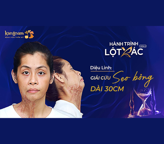 Diệu Linh giải cứu sẹo bỏng dài 30cm