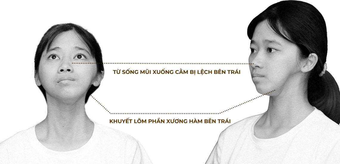 Sống mũi lệch bên trái, khuyết lõm phần xương hàm bên trái