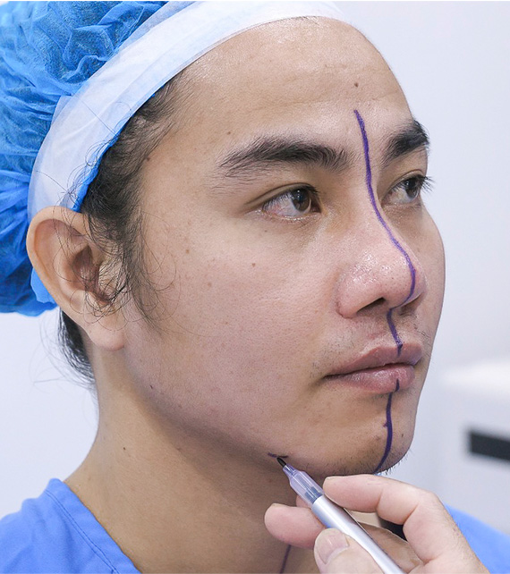 căn chỉnh hàm mặt