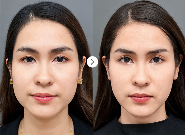 Before After Jaw 1