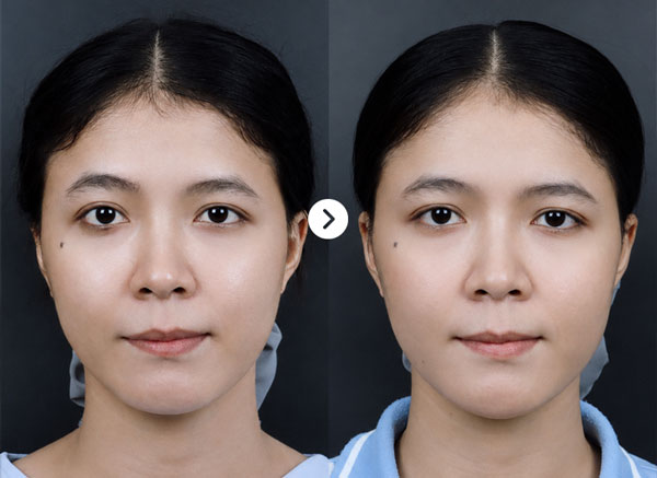 Before After Jaw 2