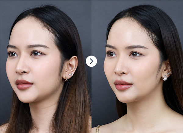 Before After Jaw 3