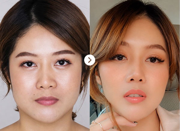 Before After Jaw 4