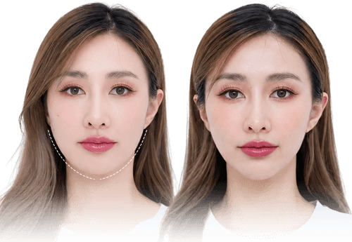 V-Line Face Comparison