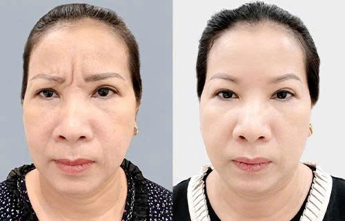 Tiêm Botox