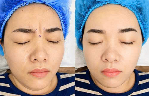 Tiêm Botox