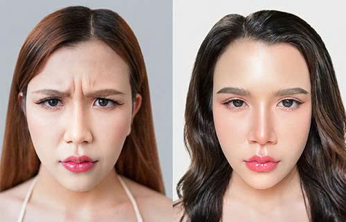 Tiêm Botox