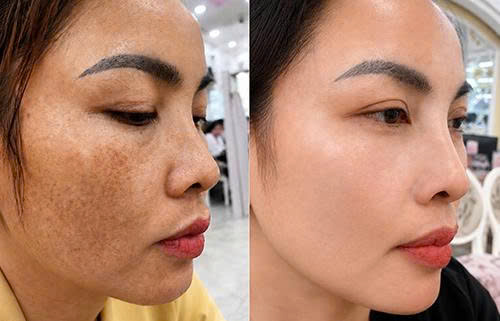 Điều trị sắc tố