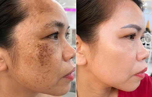 Điều trị sắc tố