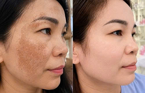 Điều trị sắc tố