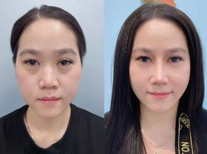 Before-After nâng mũi